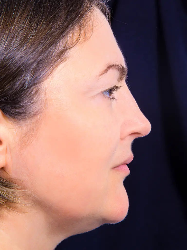 Efter-billede af sund, beroliget og balanceret hud. Resultatet af en genopbygget lipidbarriere ved brug af THE INMANIs molekylærbiologiske hudpleje.