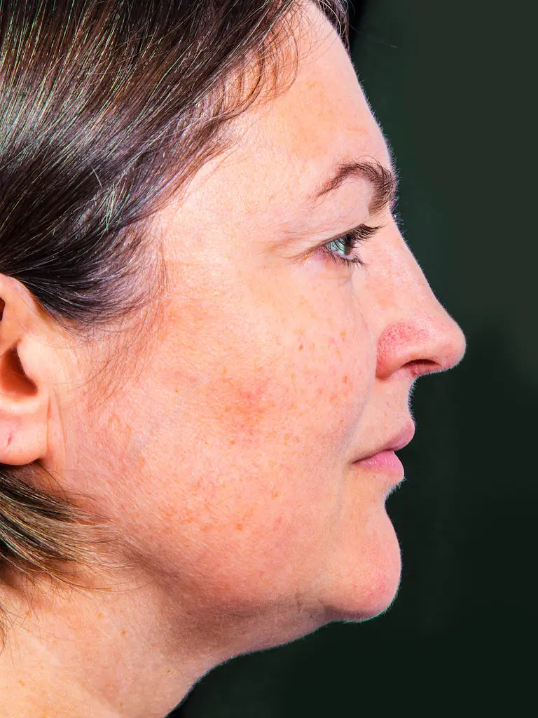 Før-billede af sensitiv og irriteret hud med en kompromitteret lipidbarriere, før behandlingen med THE INMANIs naturlige barrierepleje.